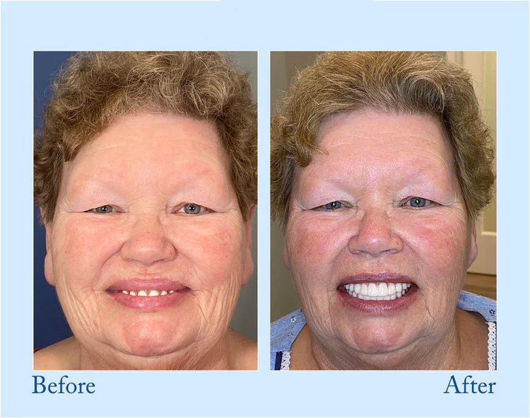š¦·Advanced Customized Full Denture Set𦷠(š„10,000+ Sold In Last 30 Day)
