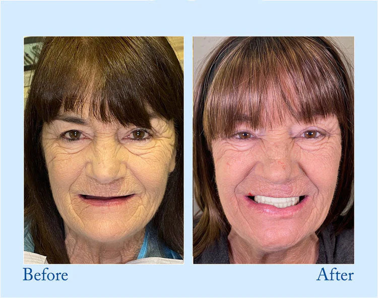 š¦·Advanced Customized Full Denture Set𦷠(š„10,000+ Sold In Last 30 Day)