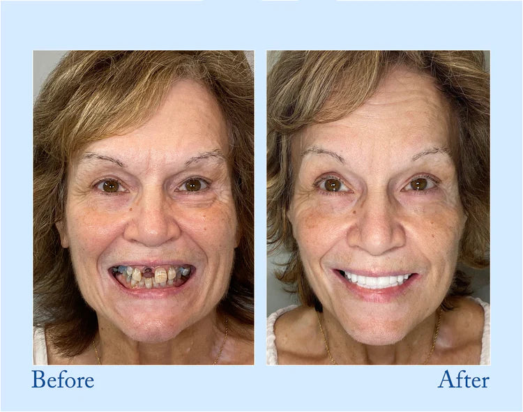🦷Advanced Customized Full Denture Set🦷  (🔥10,000+ Sold In Last 30 Day)