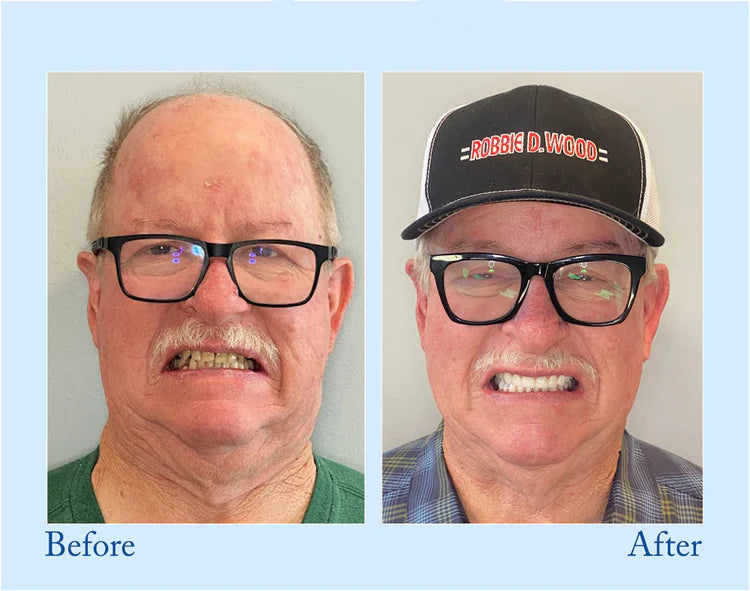🦷Advanced Customized Full Denture Set🦷  (🔥10,000+ Sold In Last 30 Day)